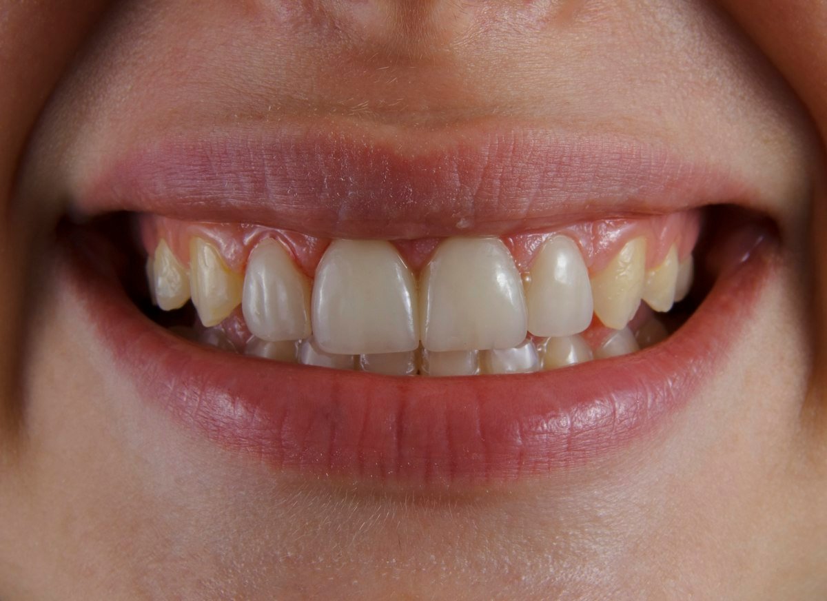 Tratamientos de estética dental en Valencia
