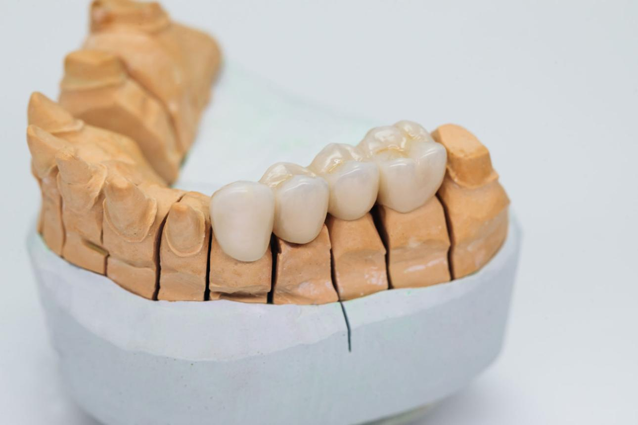 Prótesis dentales fijas y removibles en Valencia
